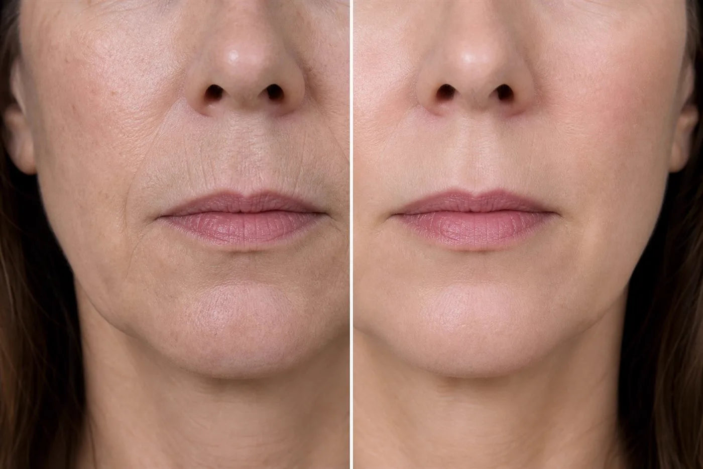 Before and after comparison of the lines around a woman's mouth
